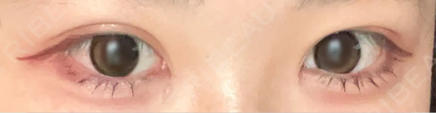 施術後の写真