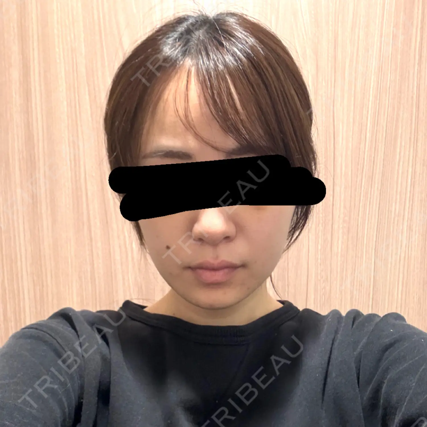 施術後の写真