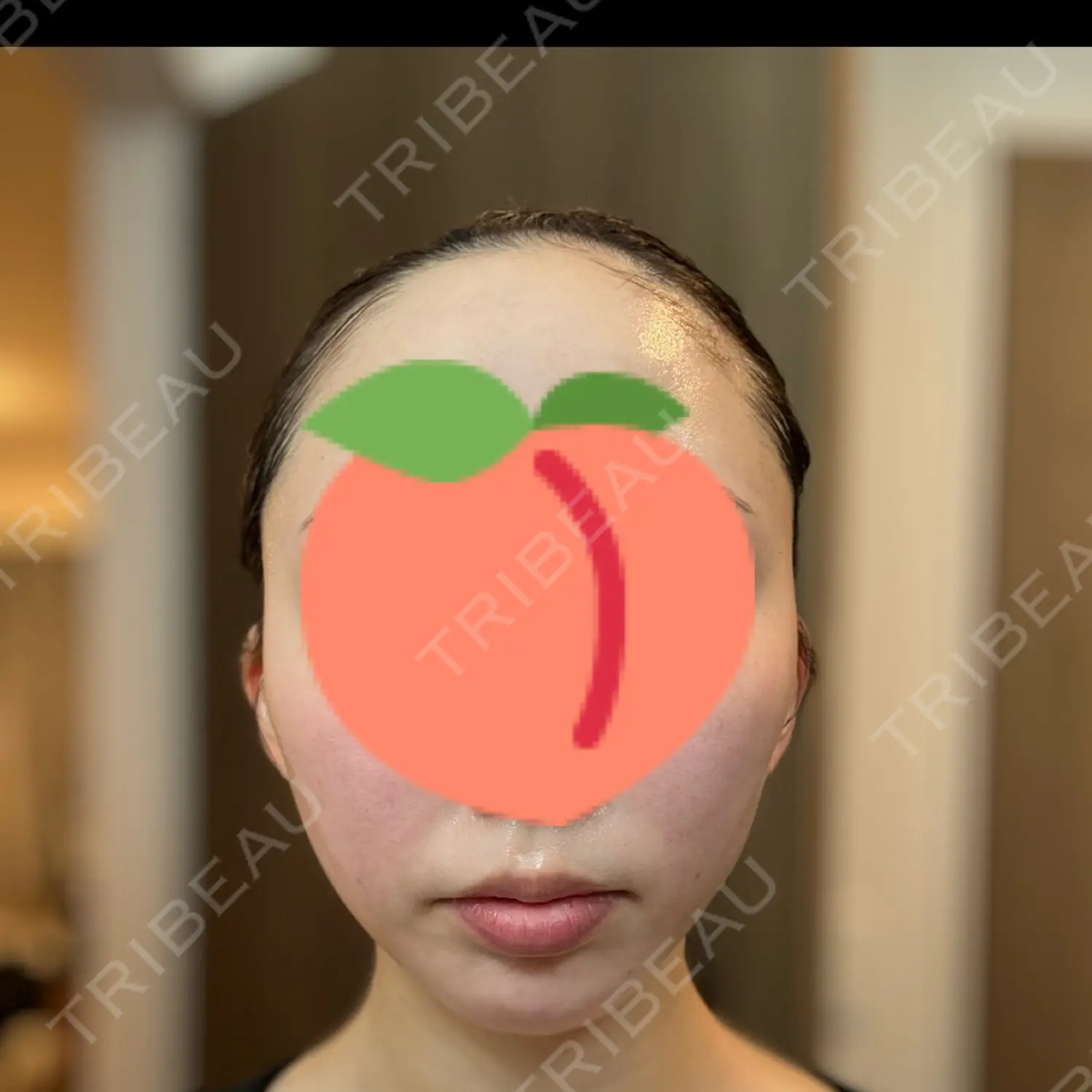 施術後の写真