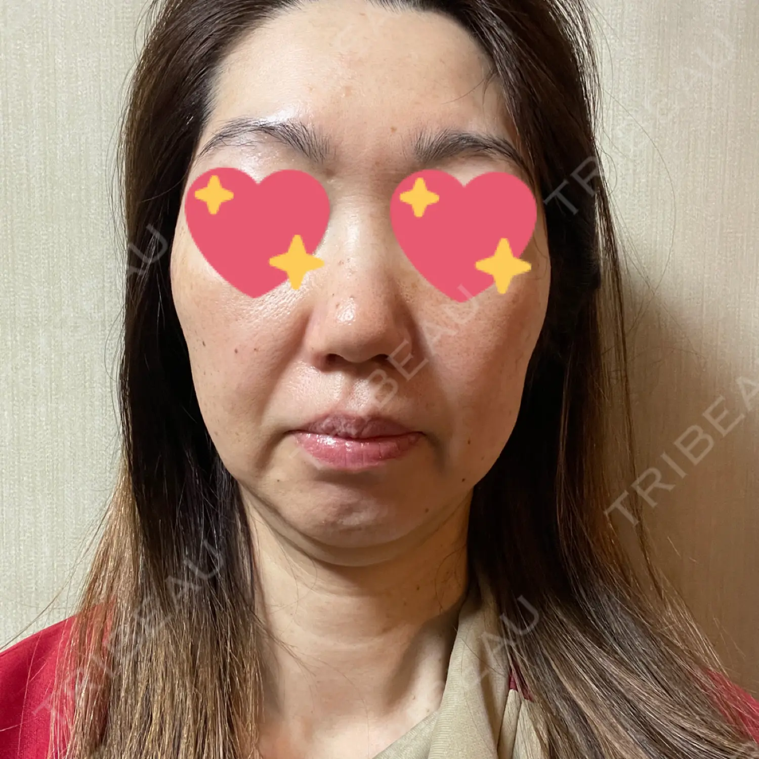施術後の写真