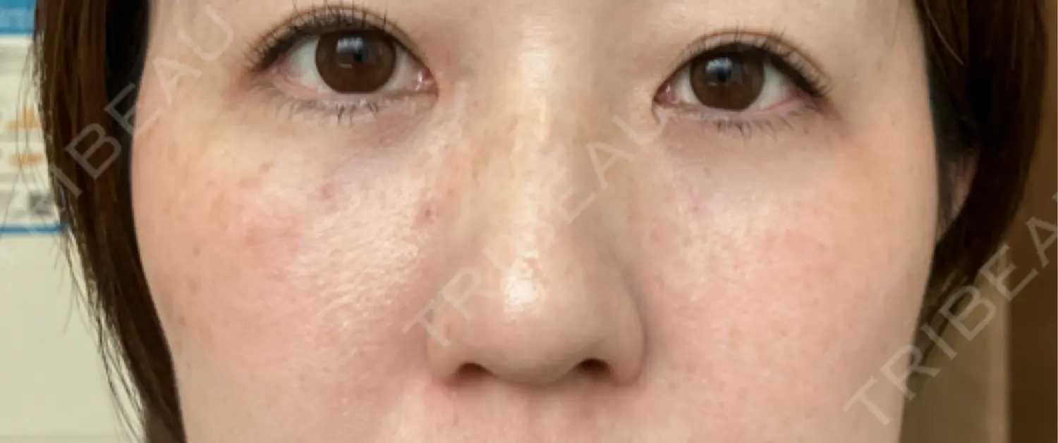 施術後の写真