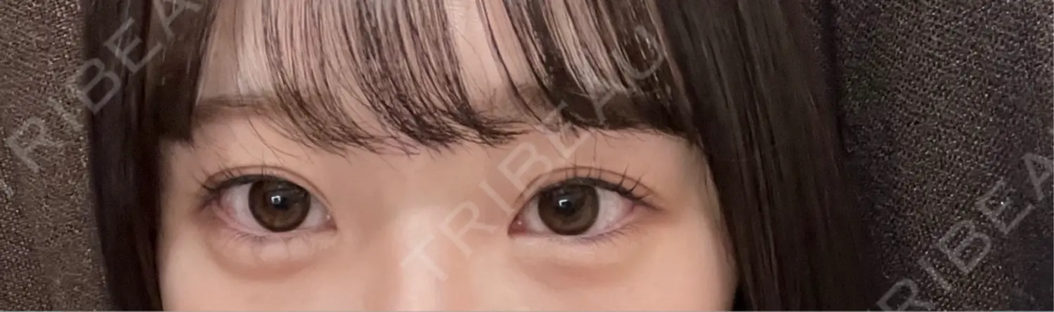施術後の写真