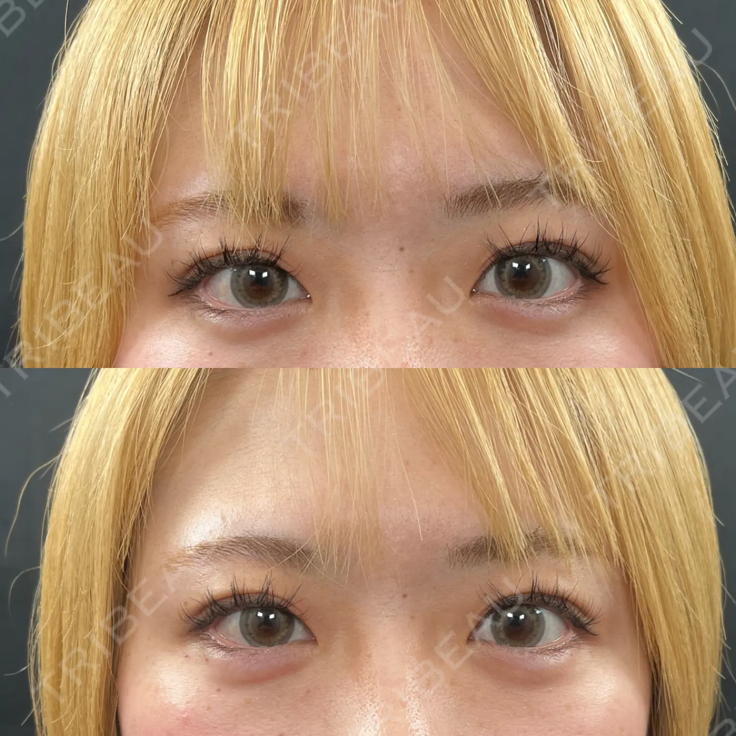 施術後の写真