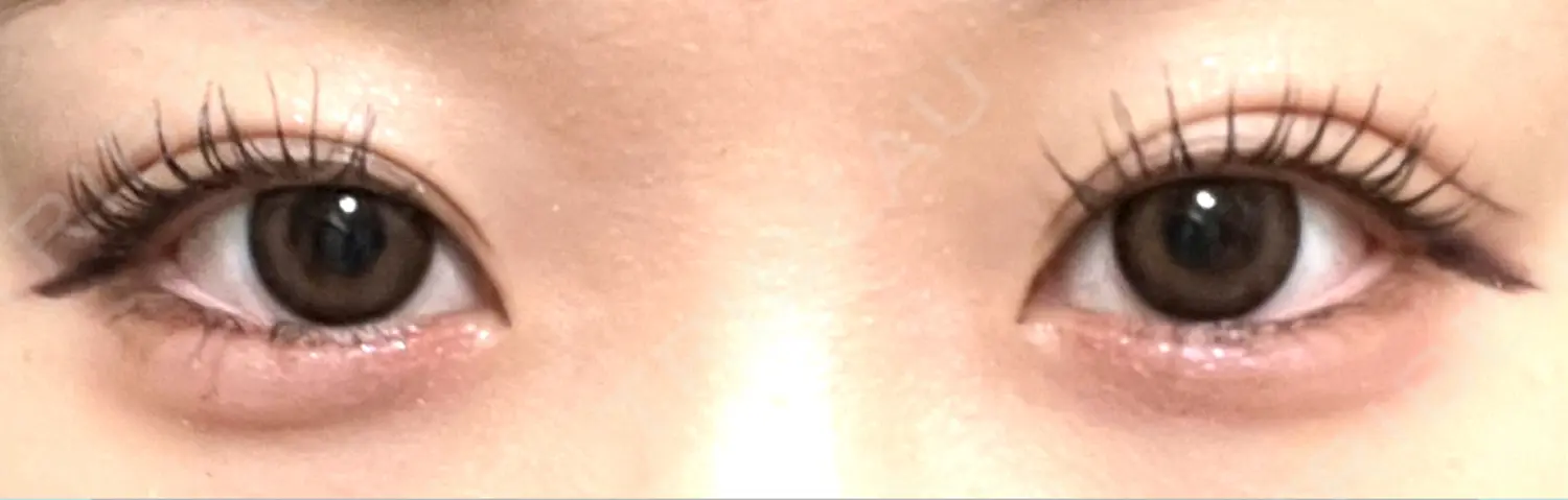 施術後の写真
