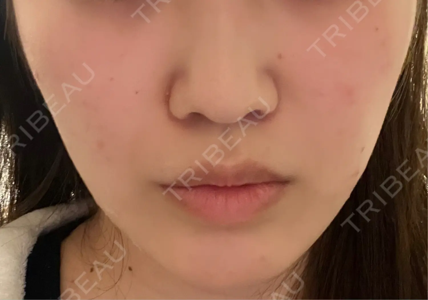 施術後の写真