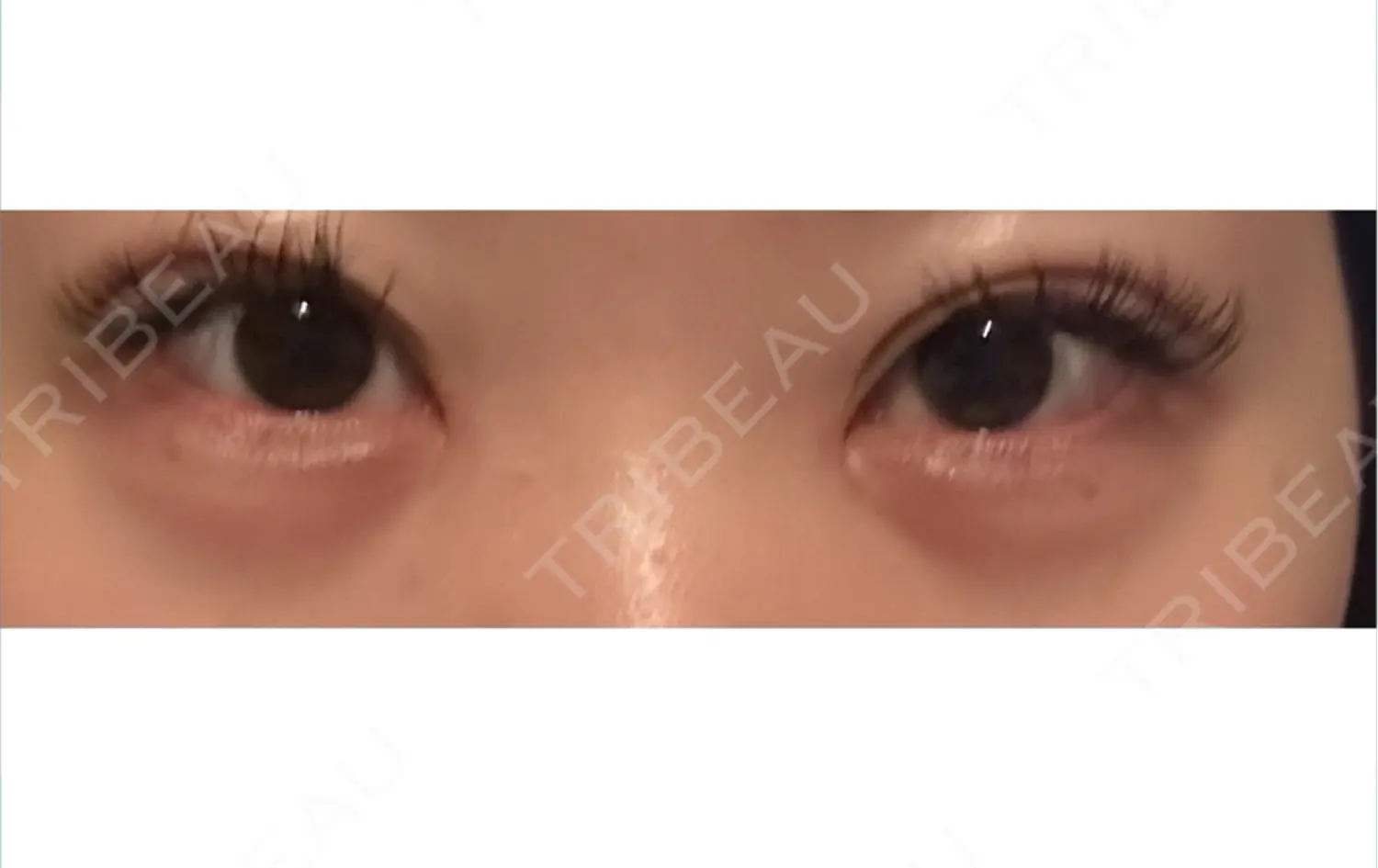 施術後の写真