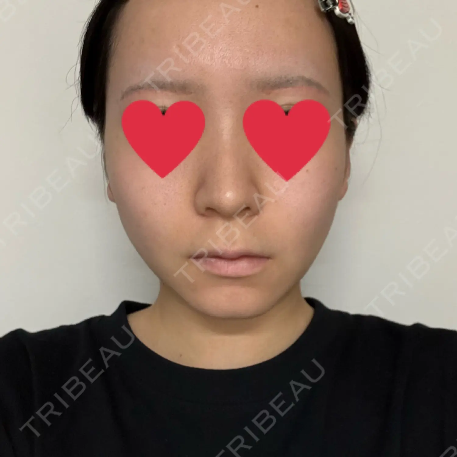 施術後の写真
