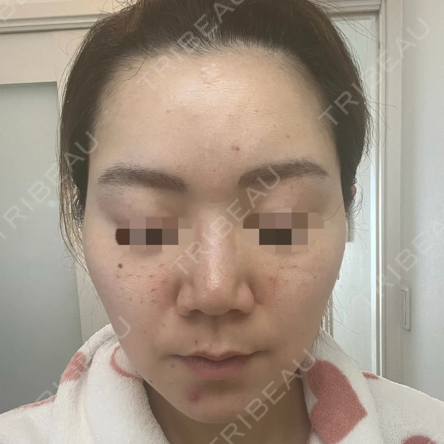 施術後の写真