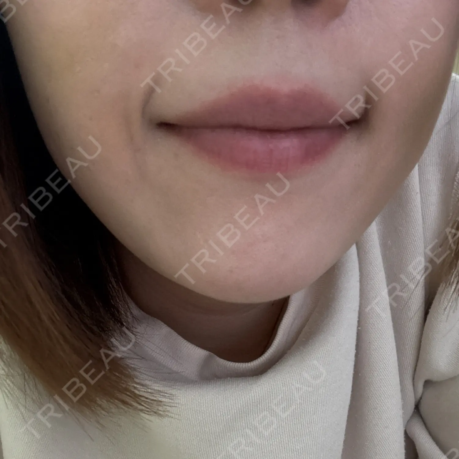 施術後の写真