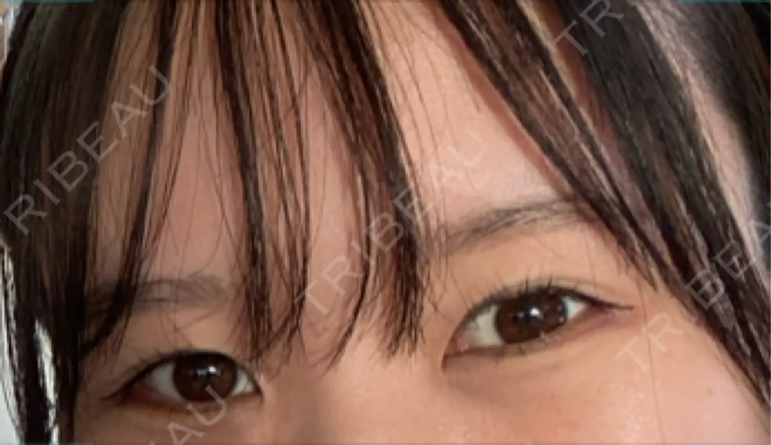 施術後の写真
