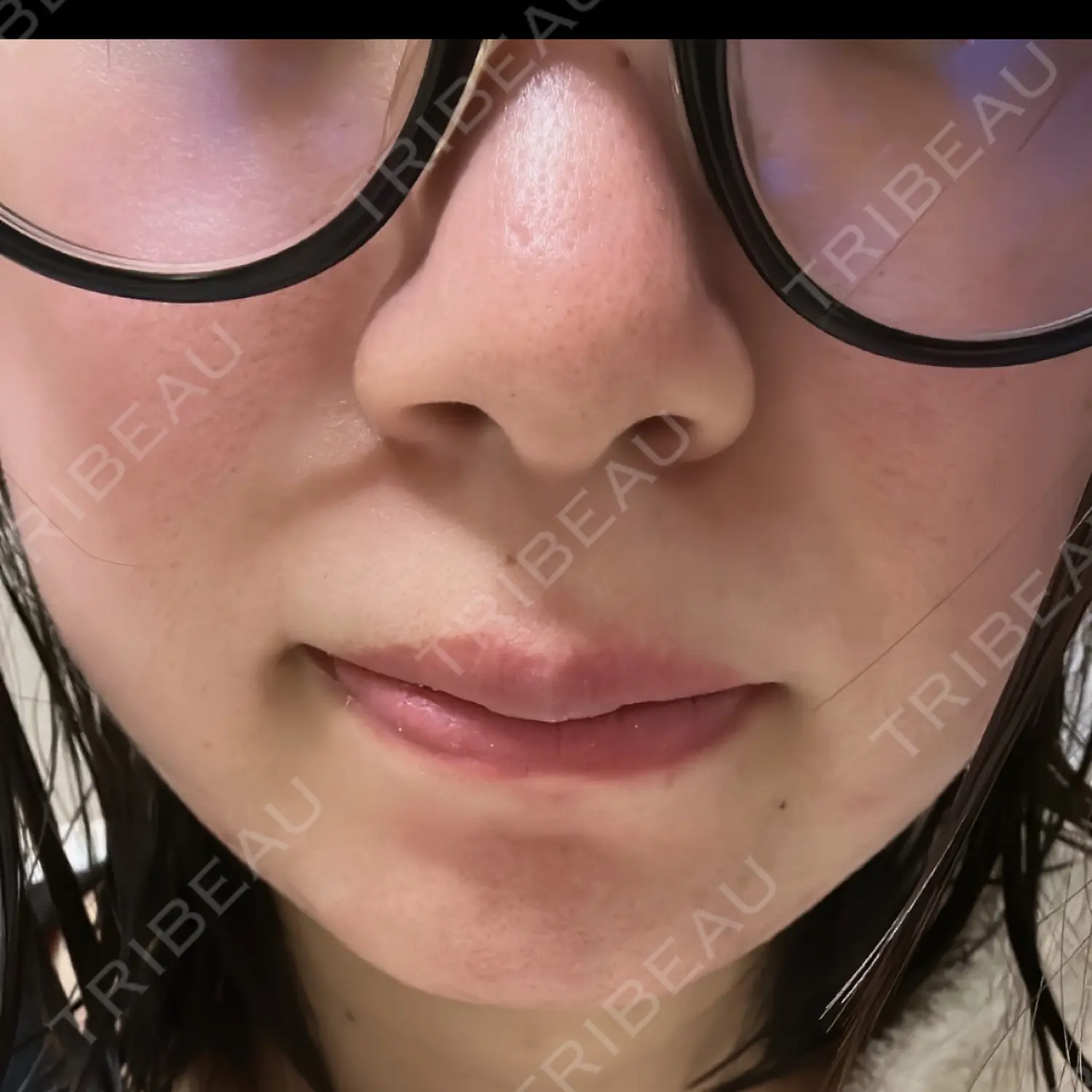施術後の写真