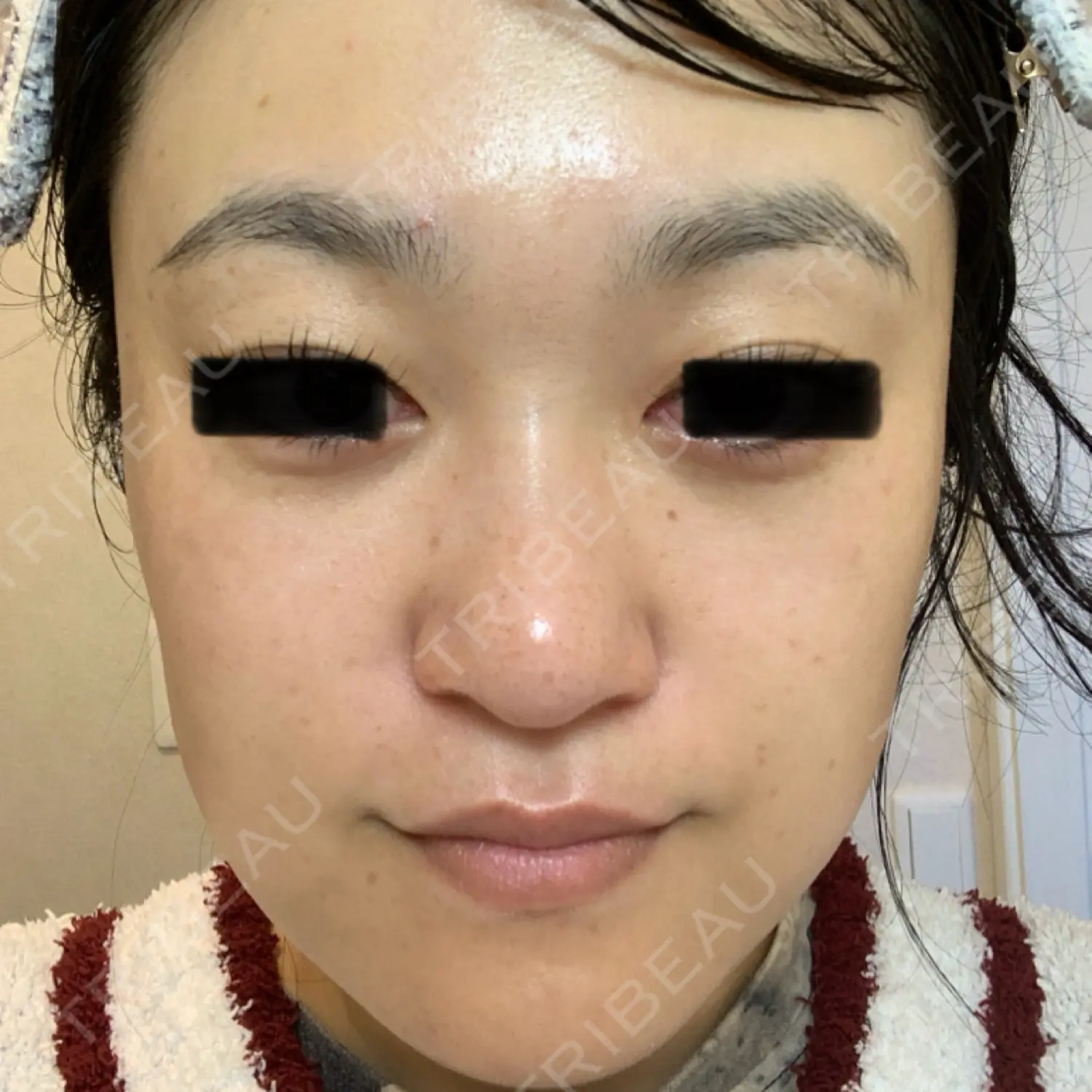 施術後の写真