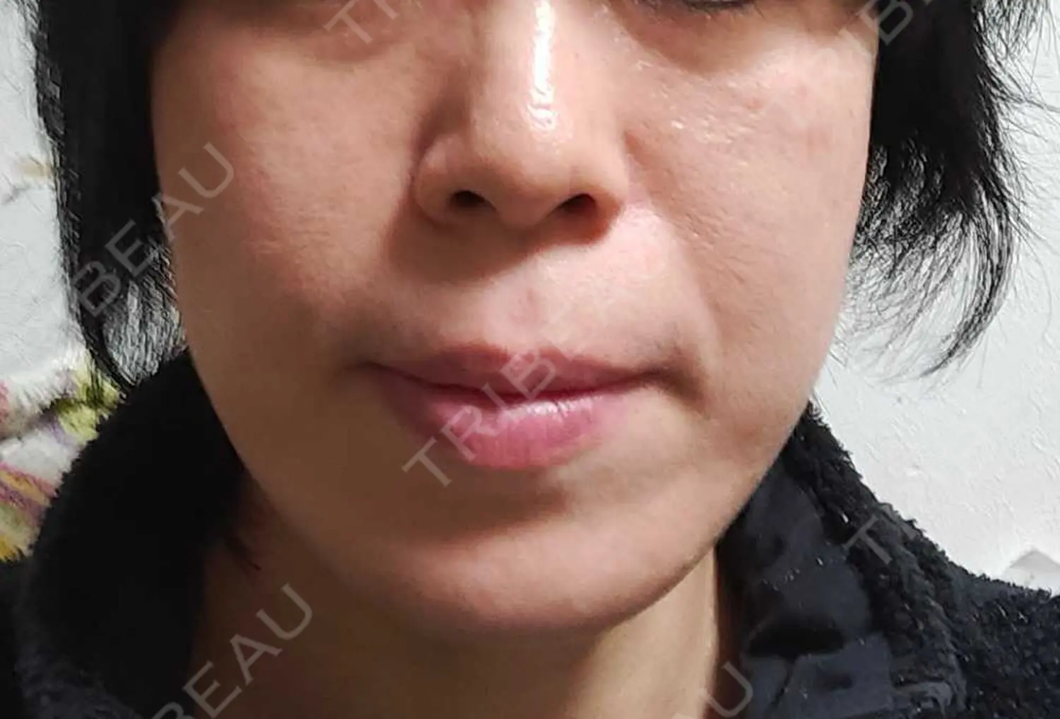施術後の写真