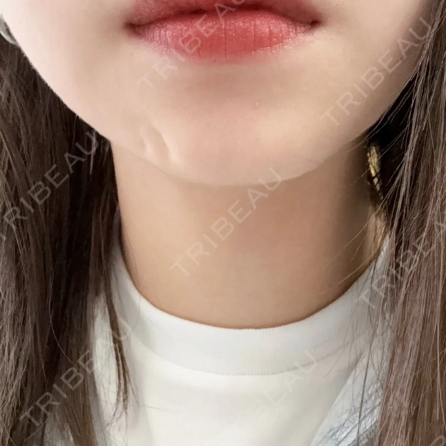 施術後の写真