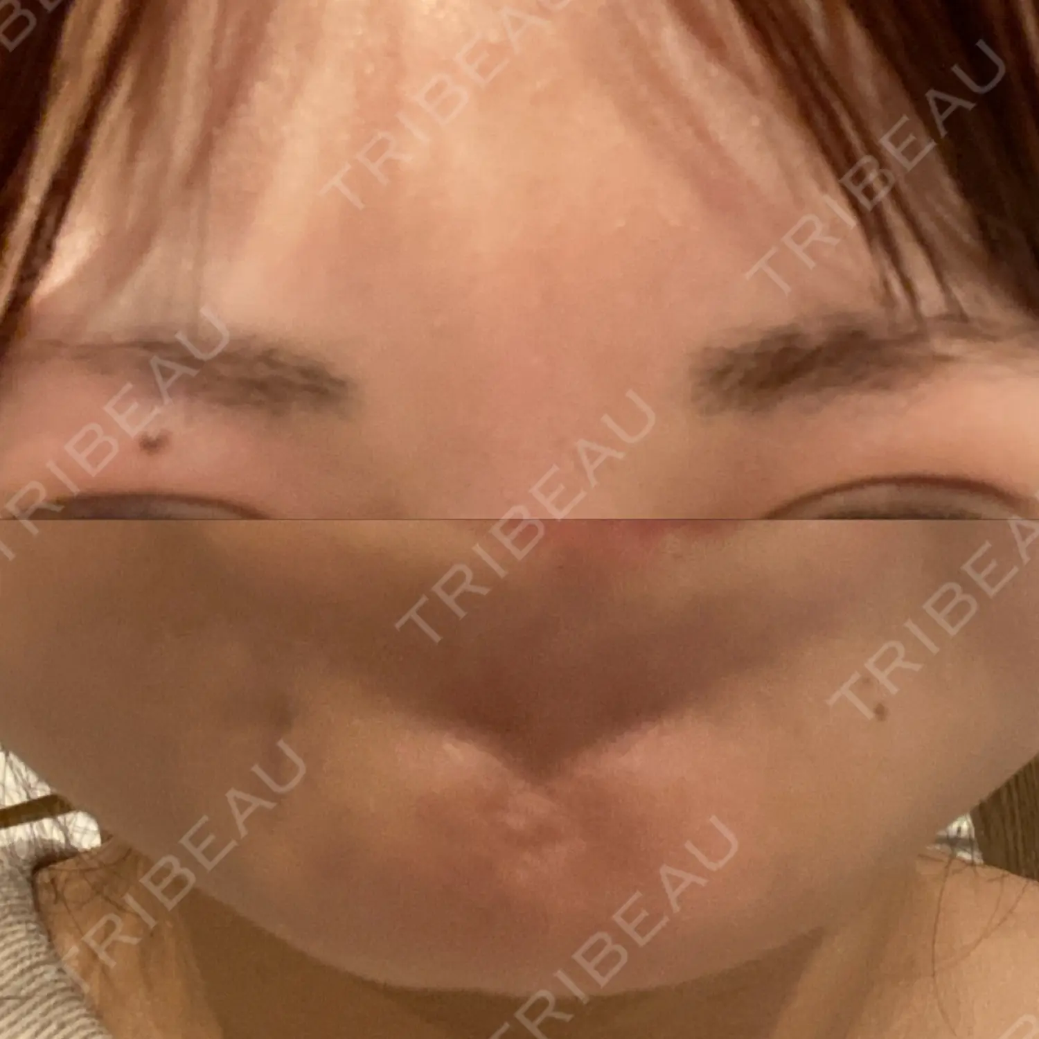 施術後の写真
