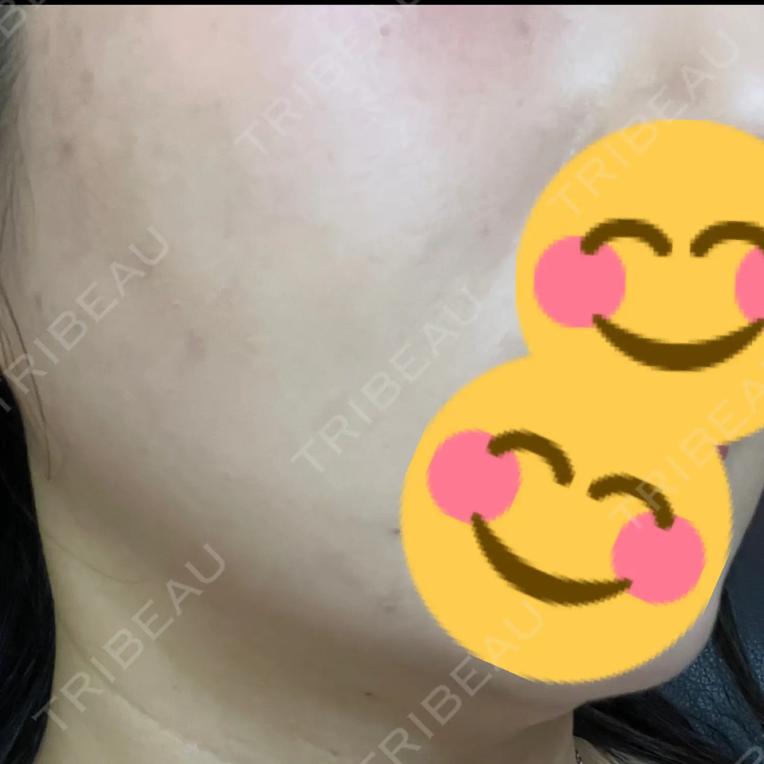 施術後の写真