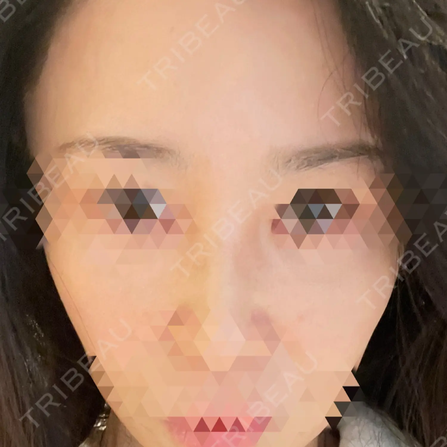 施術後の写真