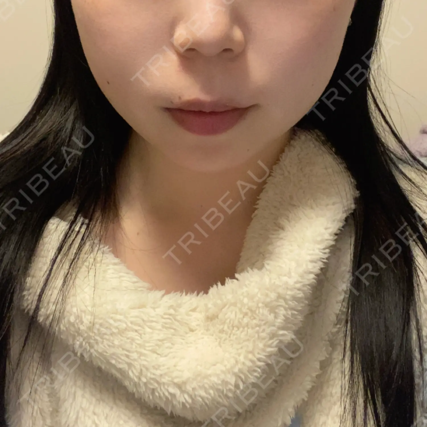 施術後の写真
