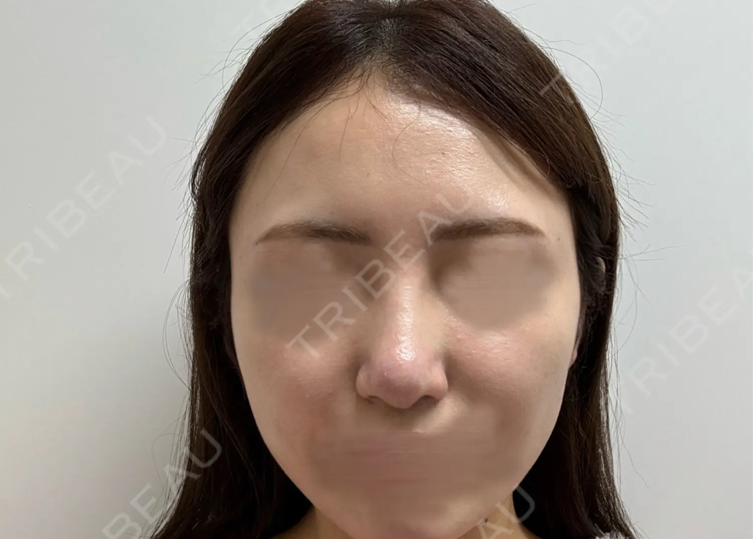 施術後の写真