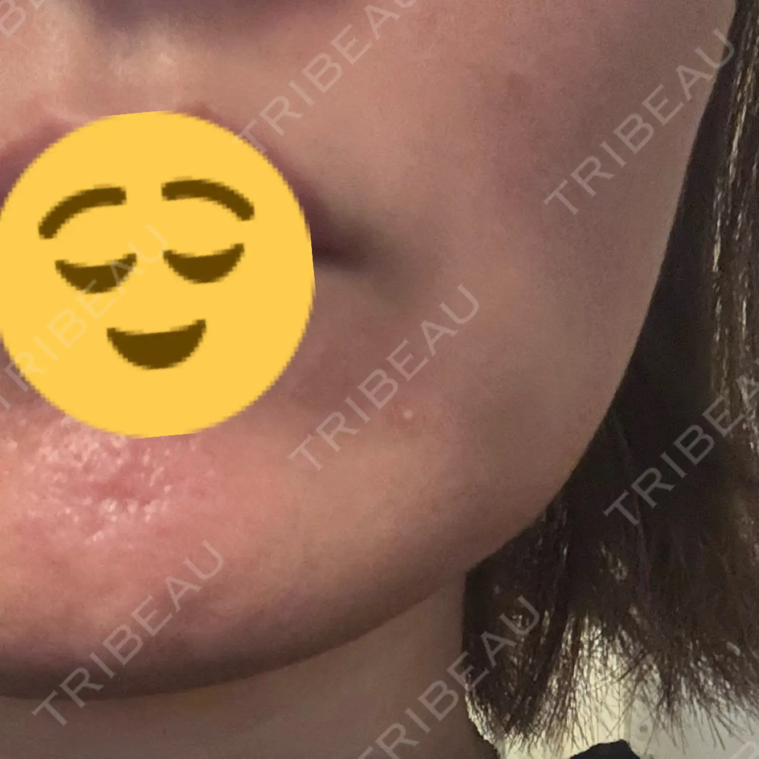 施術後の写真