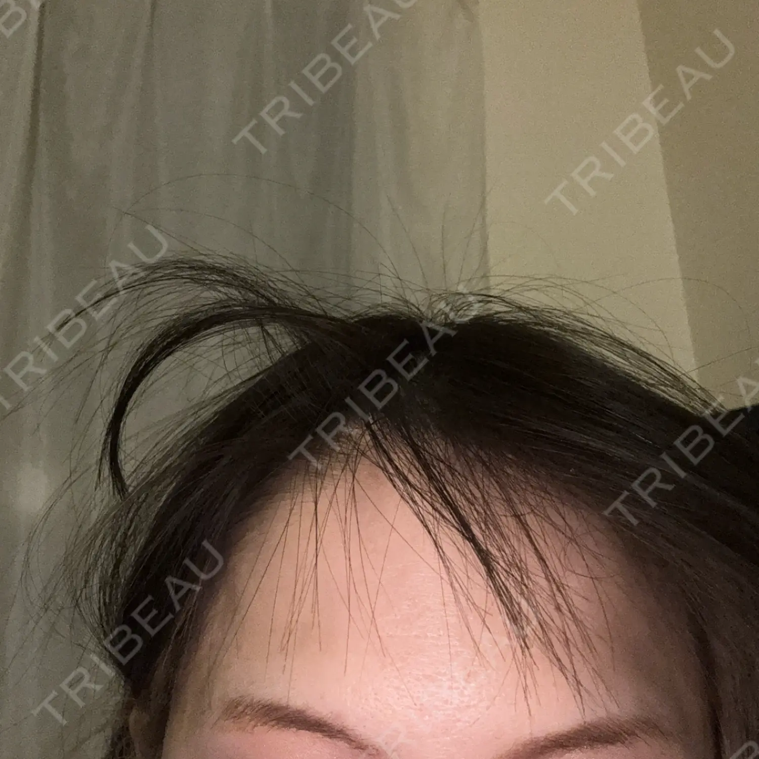 施術後の写真