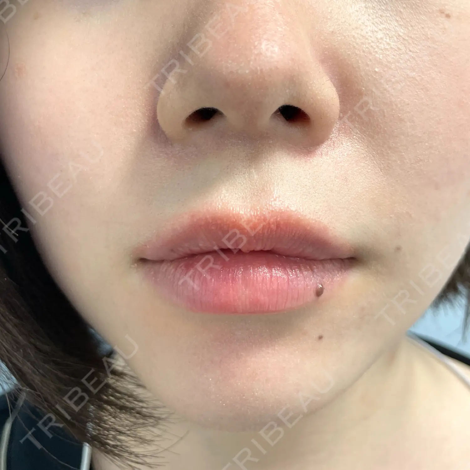 施術後の写真