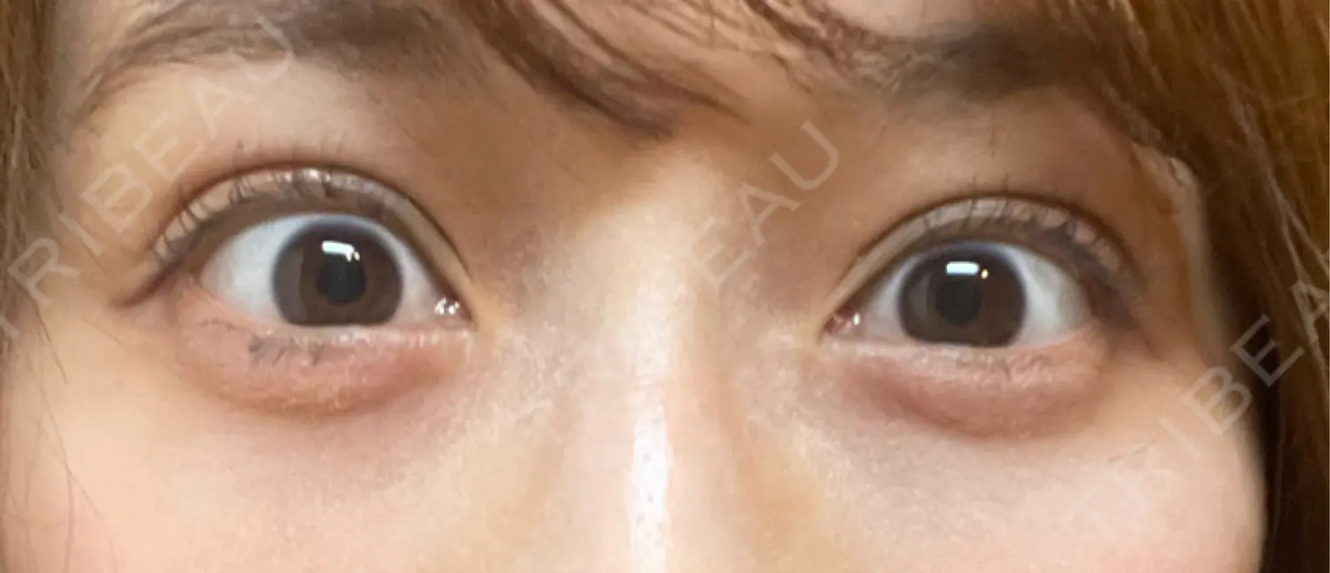 施術後の写真