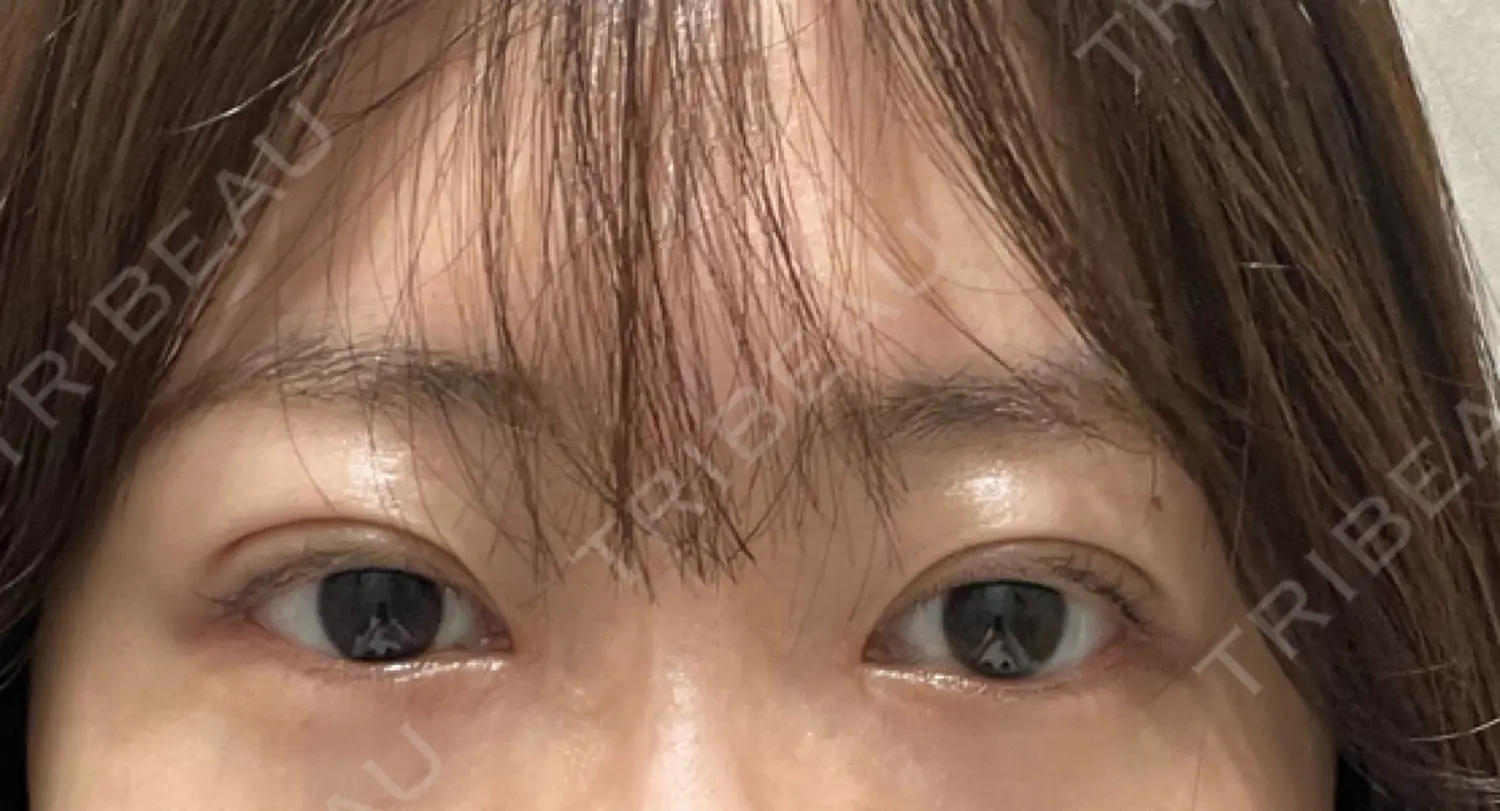 施術後の写真