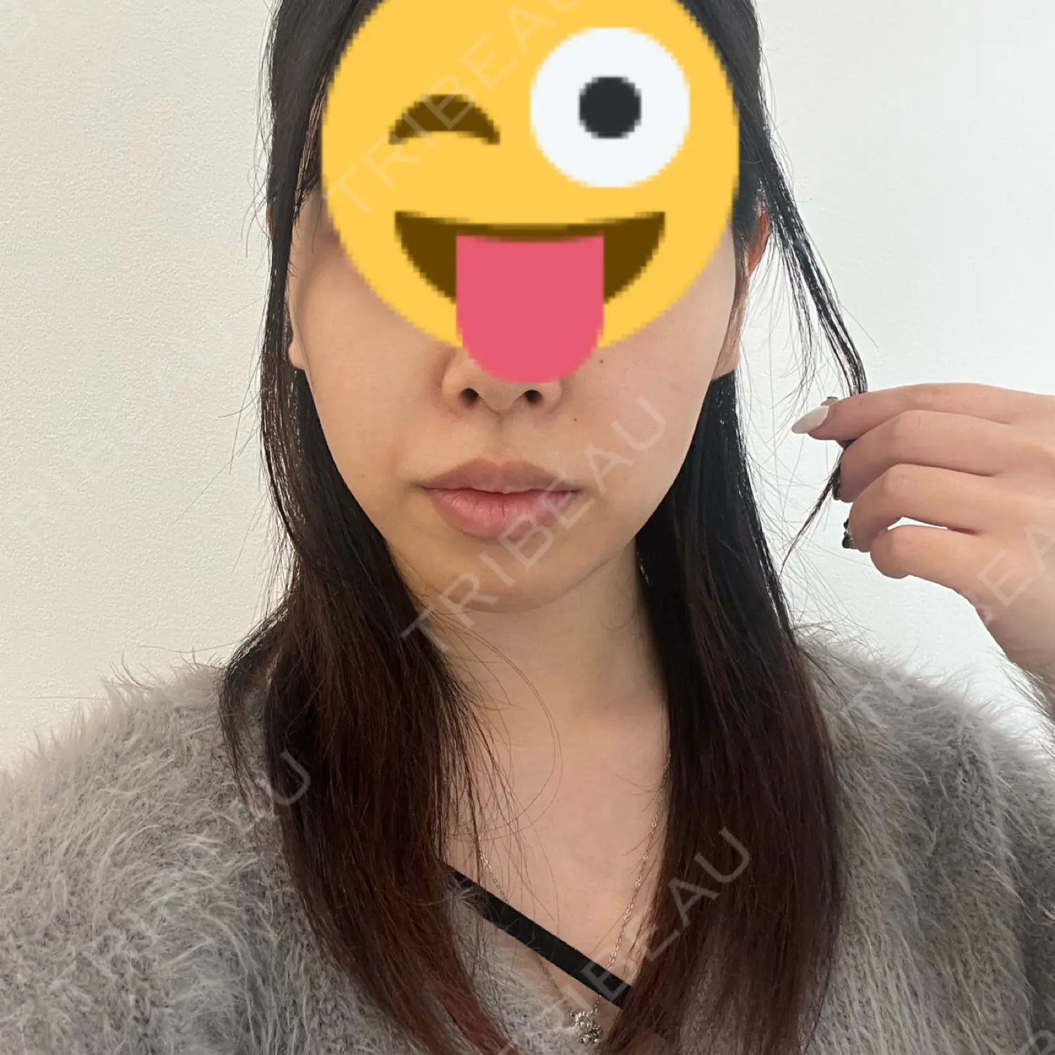 施術後の写真