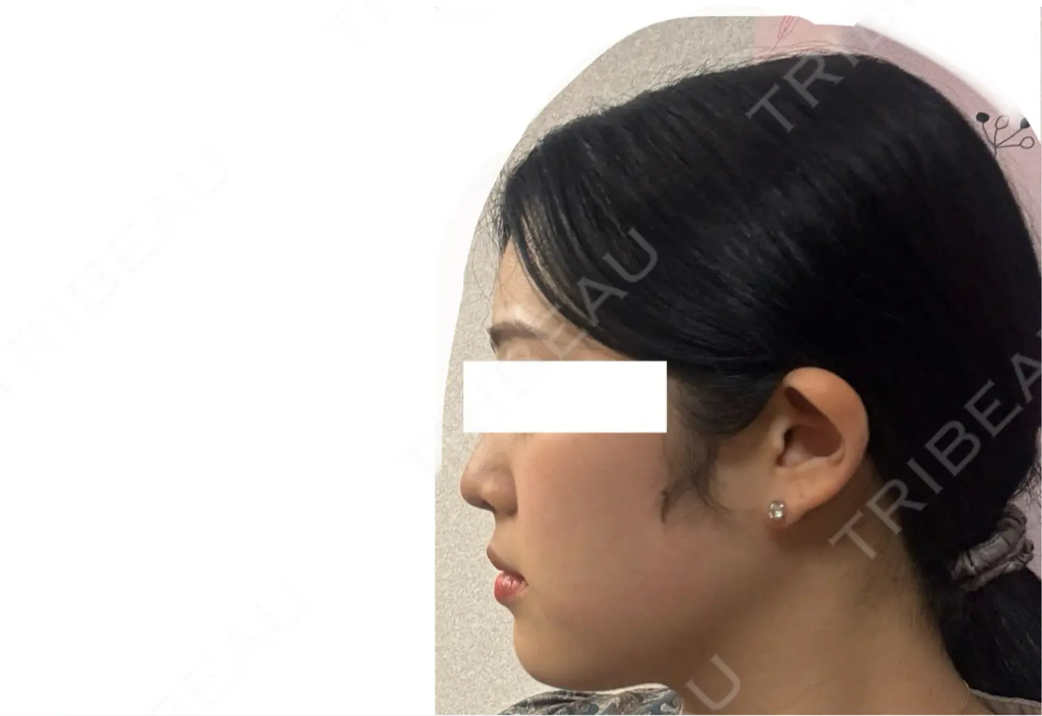 施術後の写真
