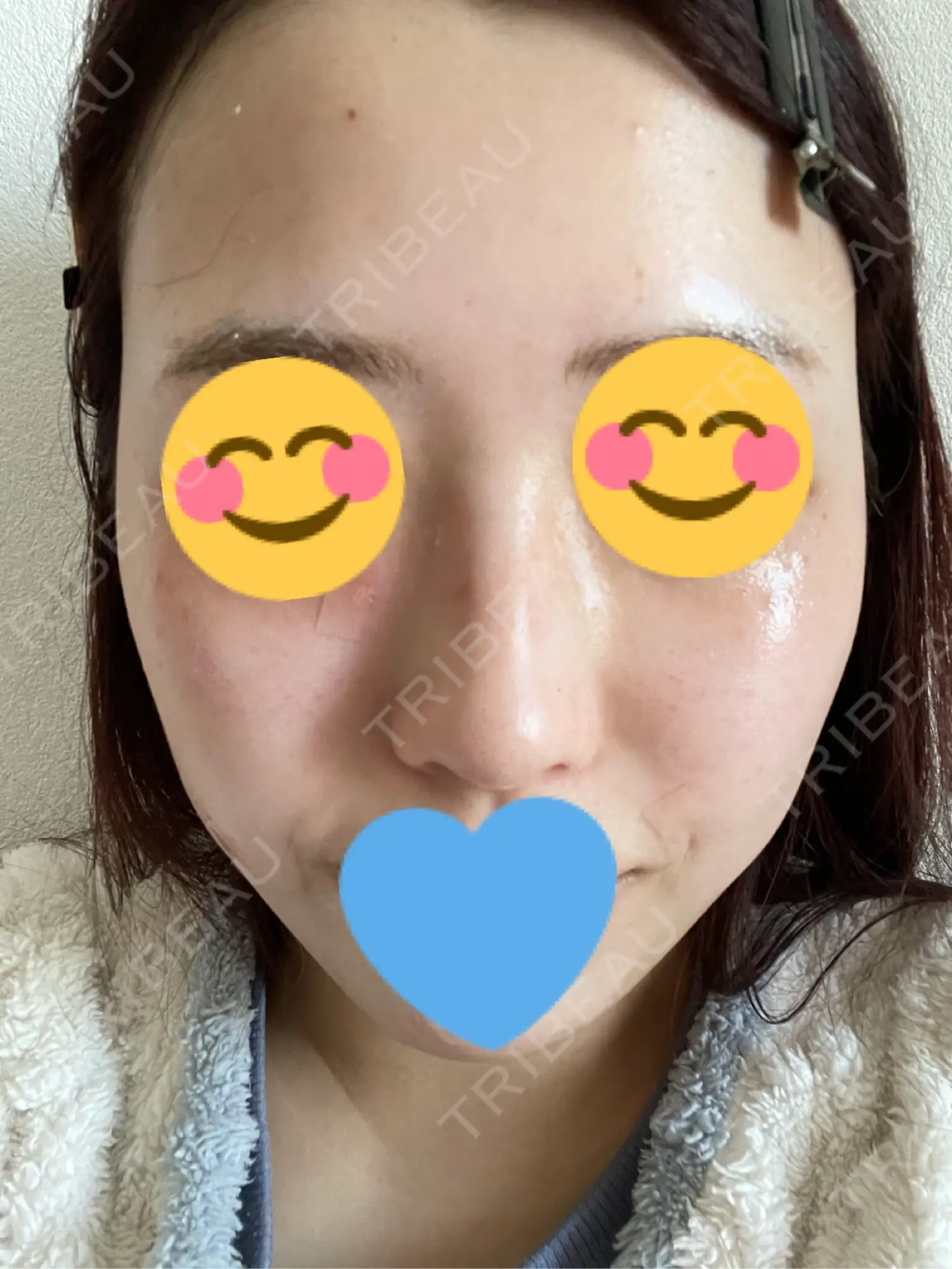 施術後の写真