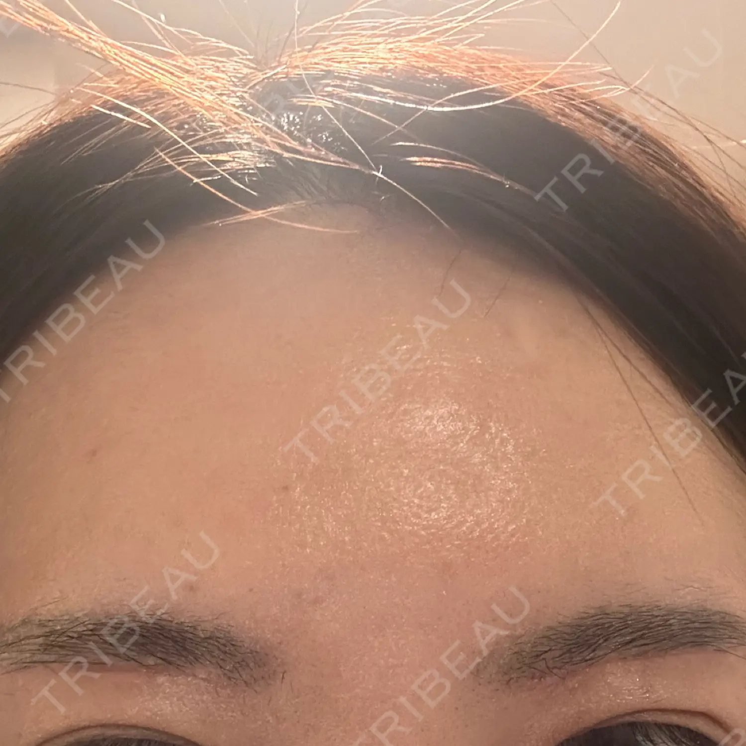 施術後の写真