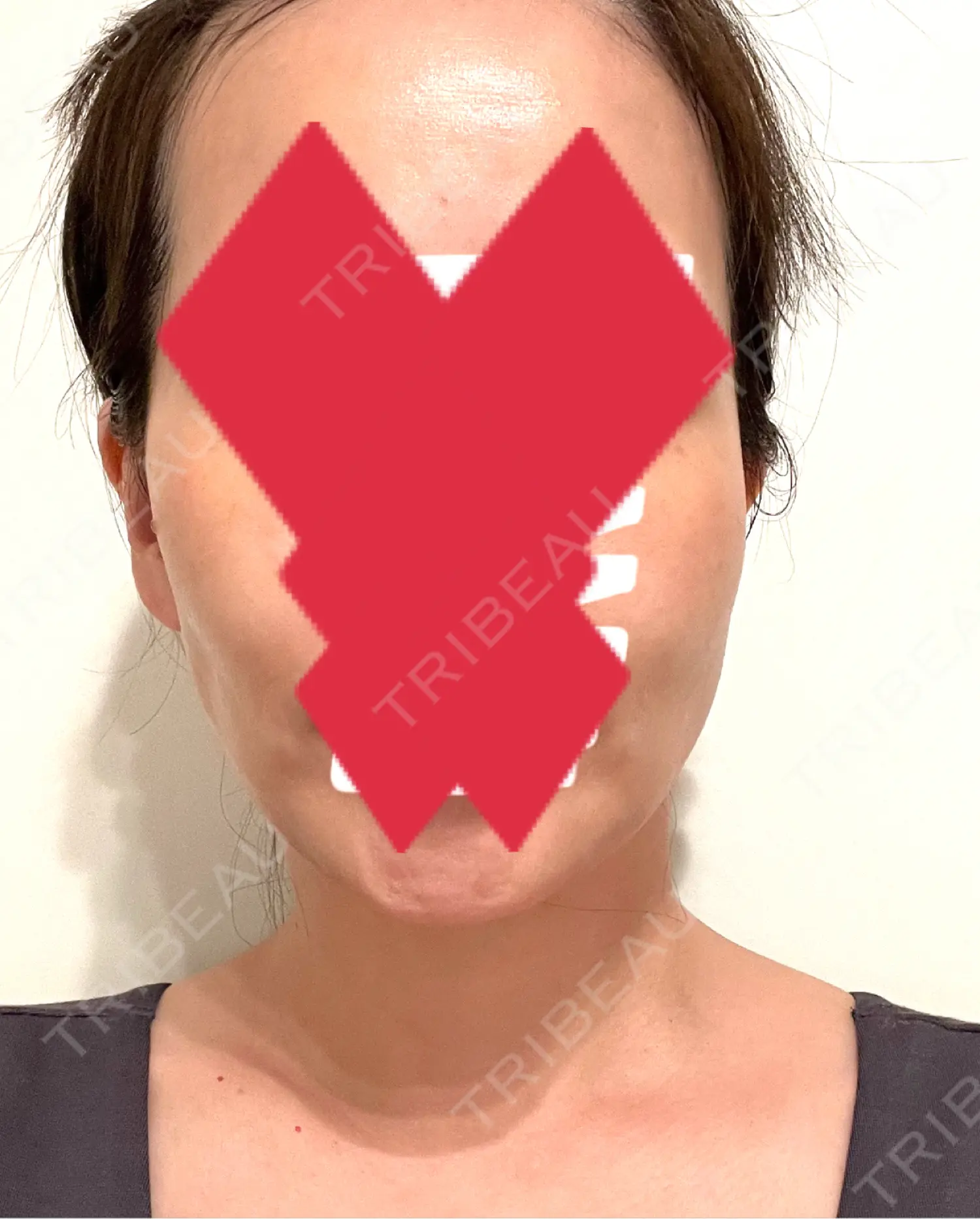 施術後の写真