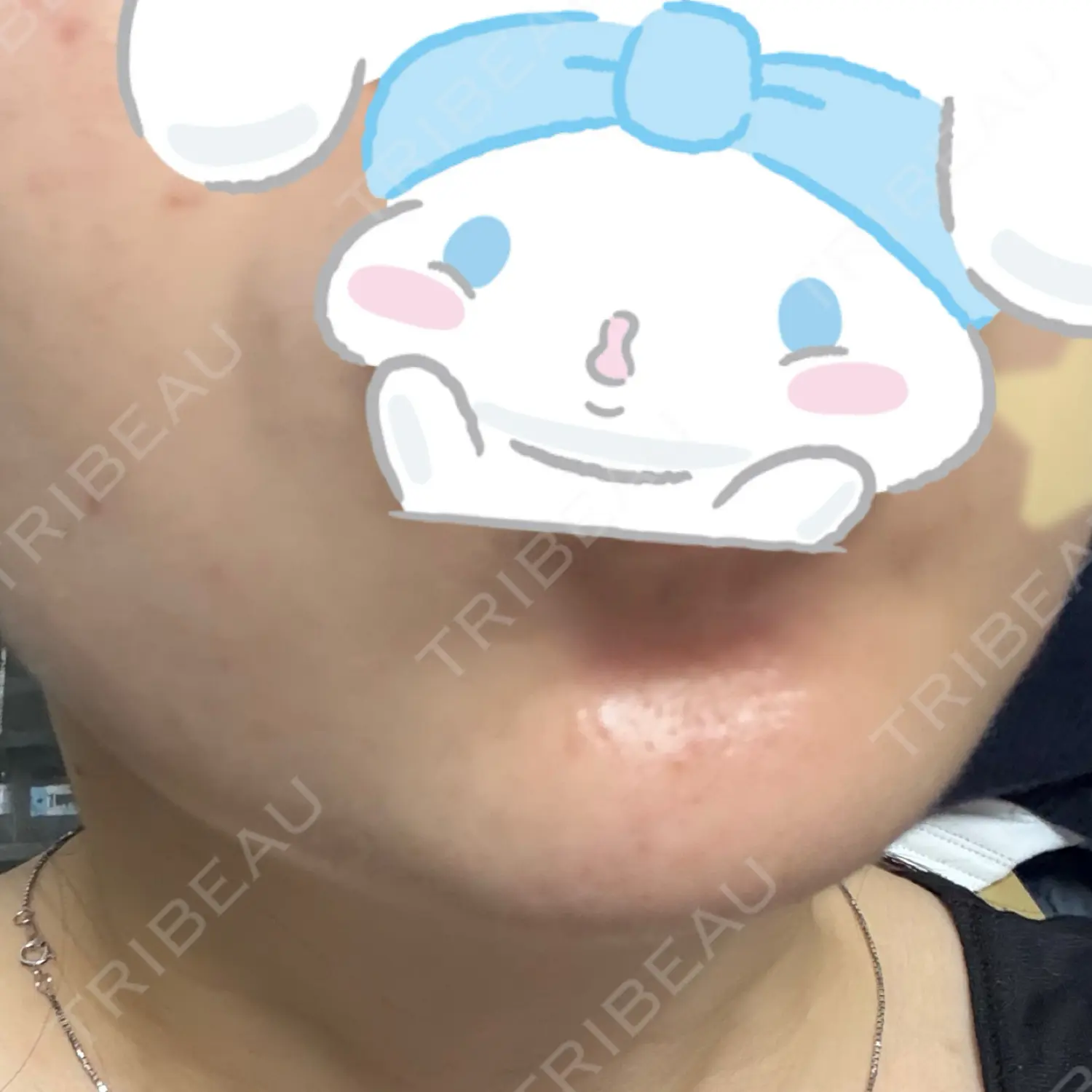 施術後の写真