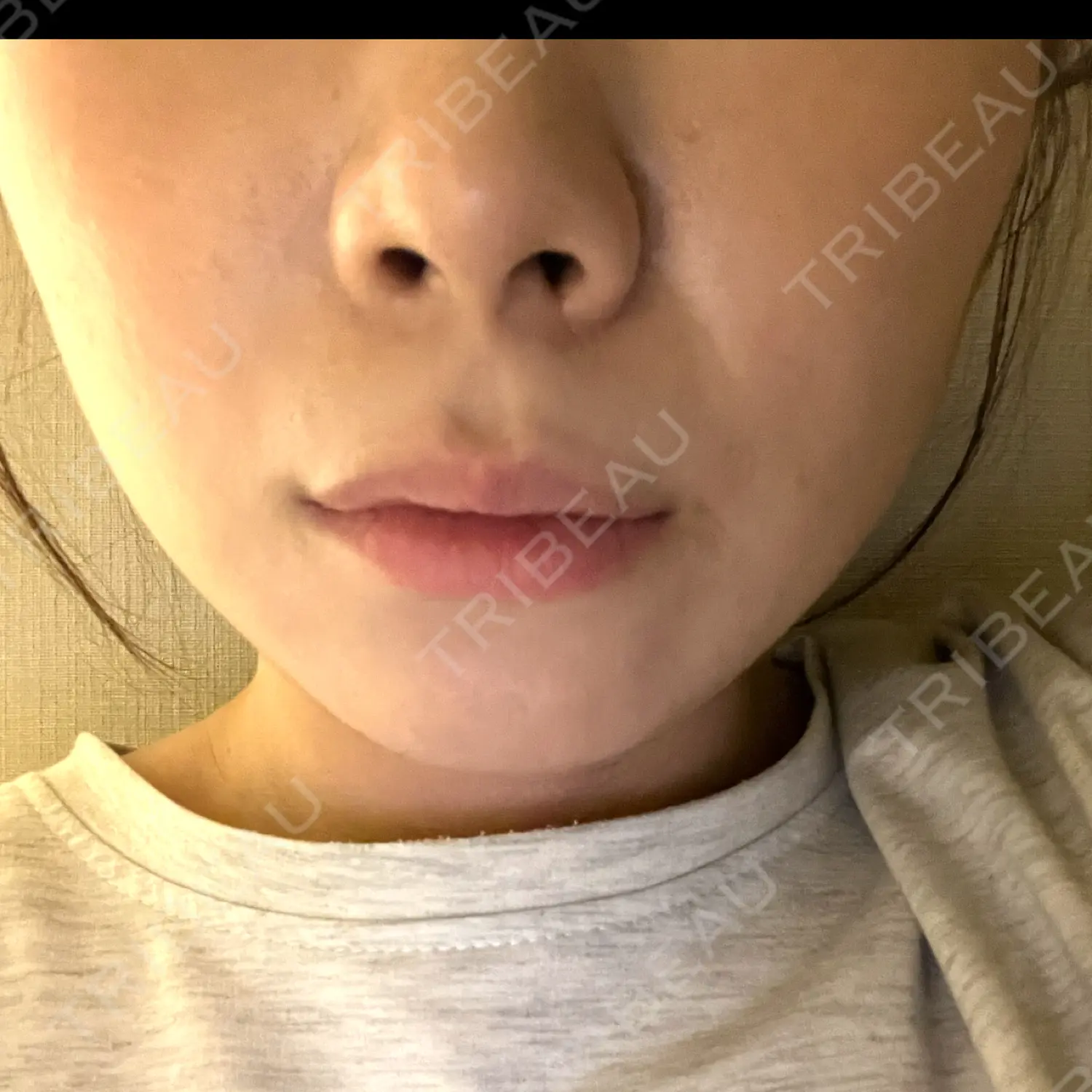 施術後の写真