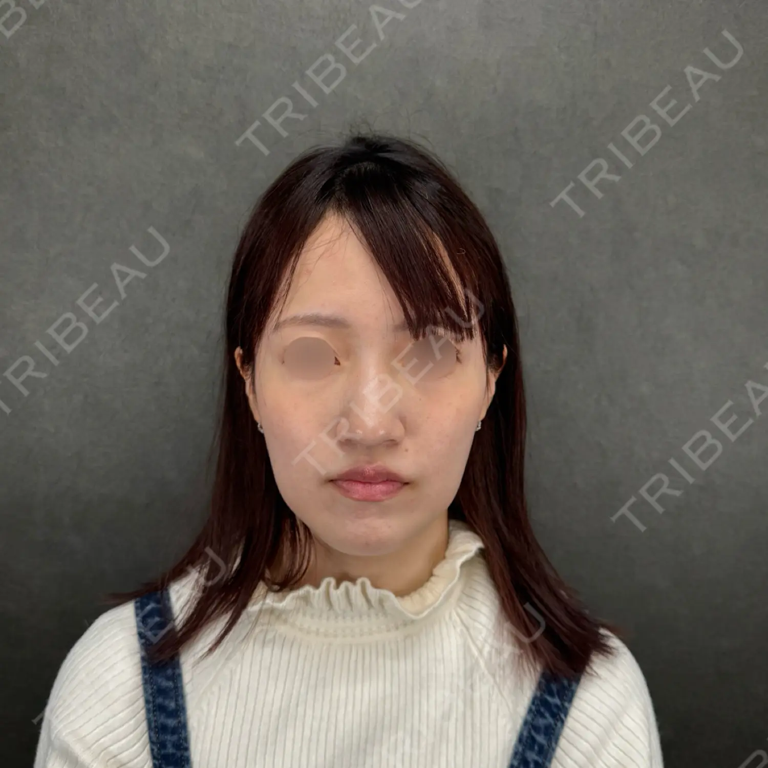 施術後の写真