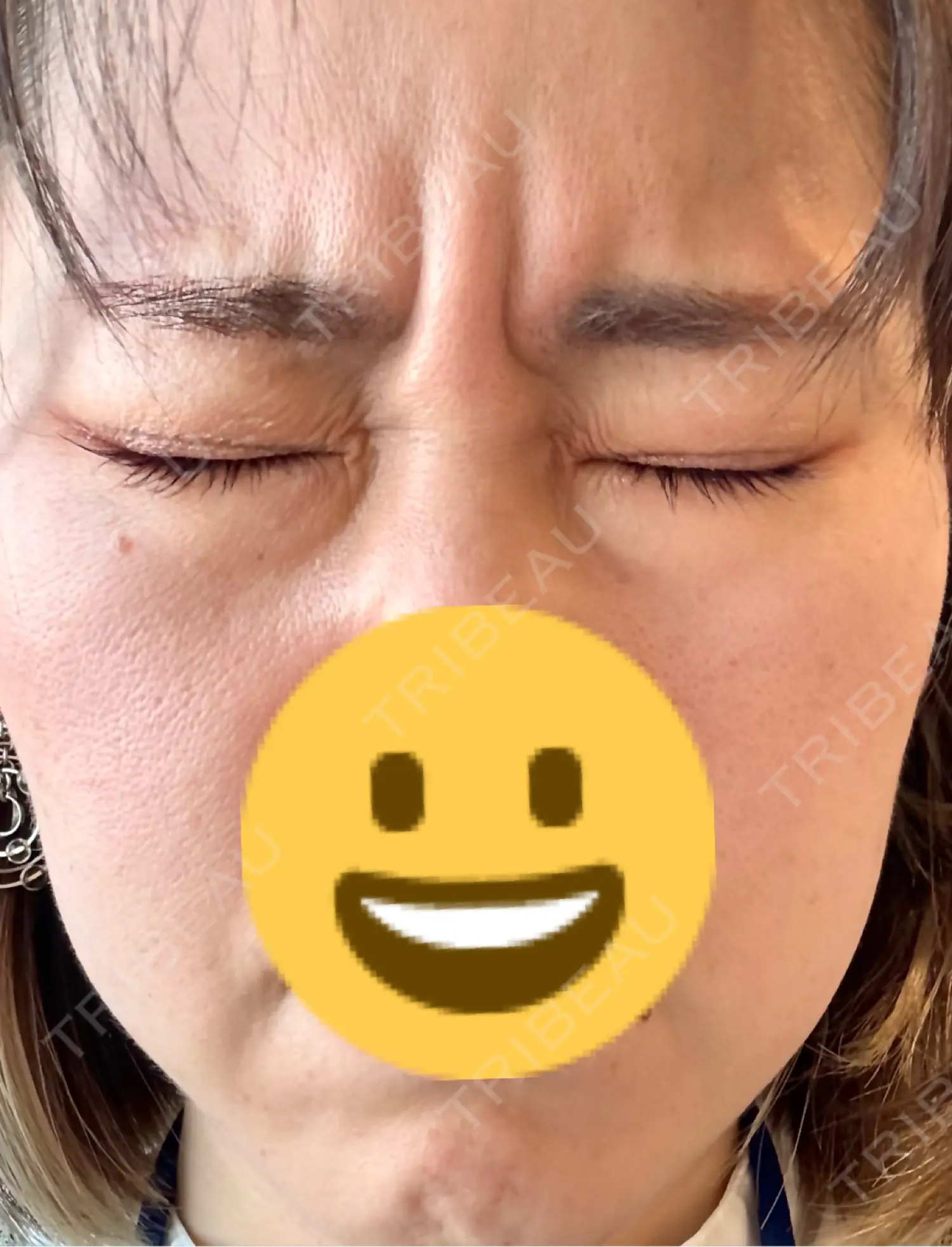 施術後の写真