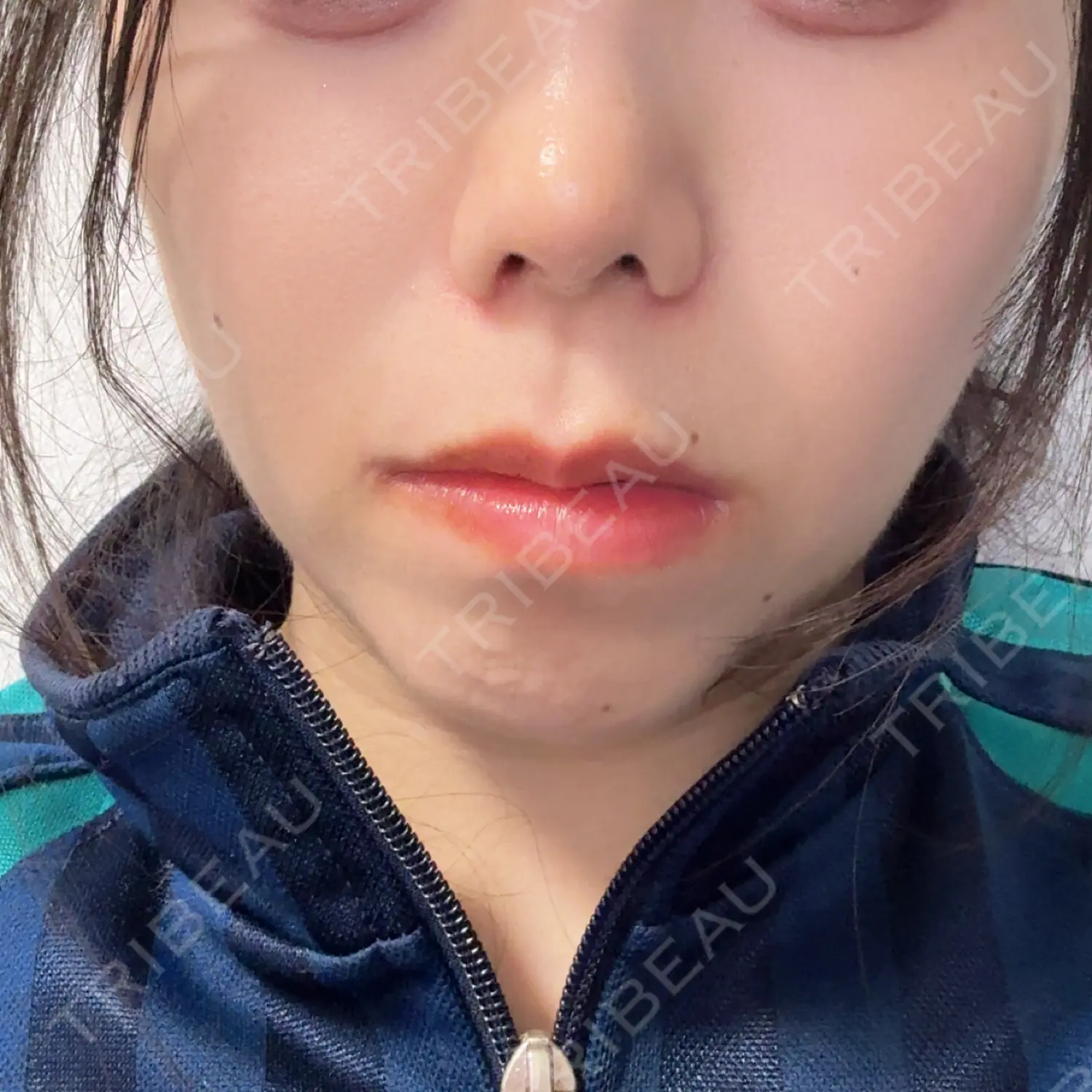 施術後の写真