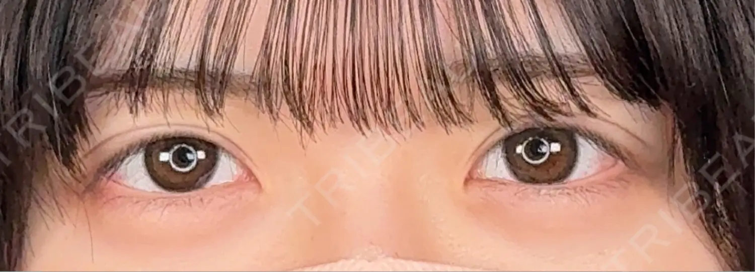 施術後の写真