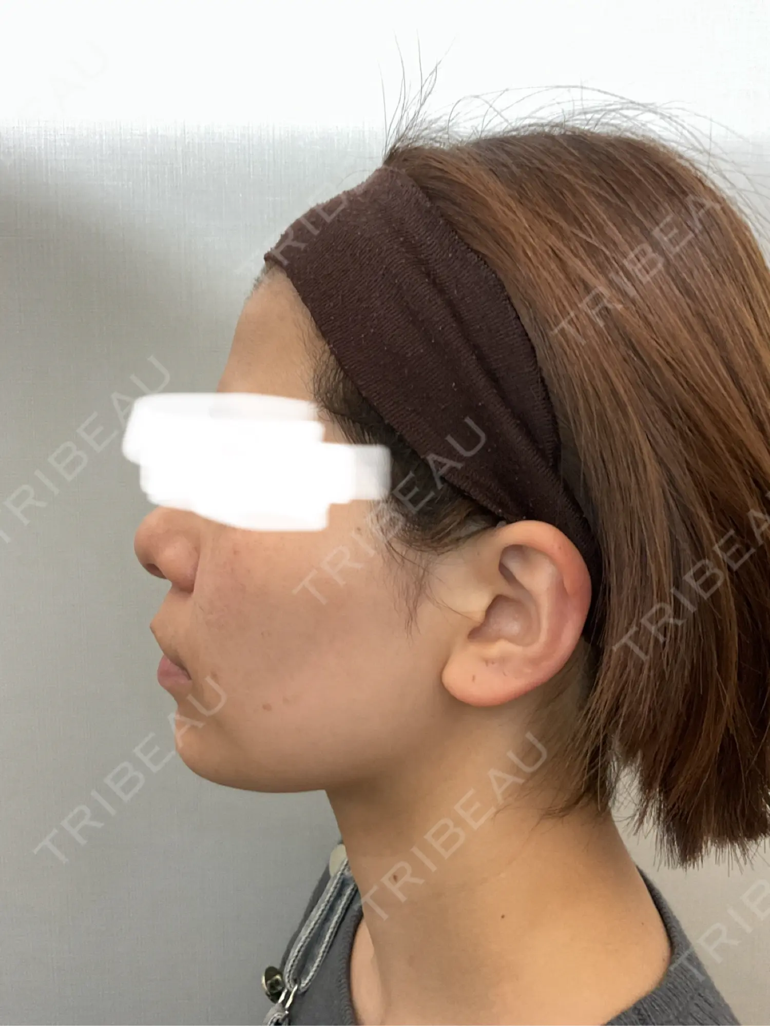 施術後の写真