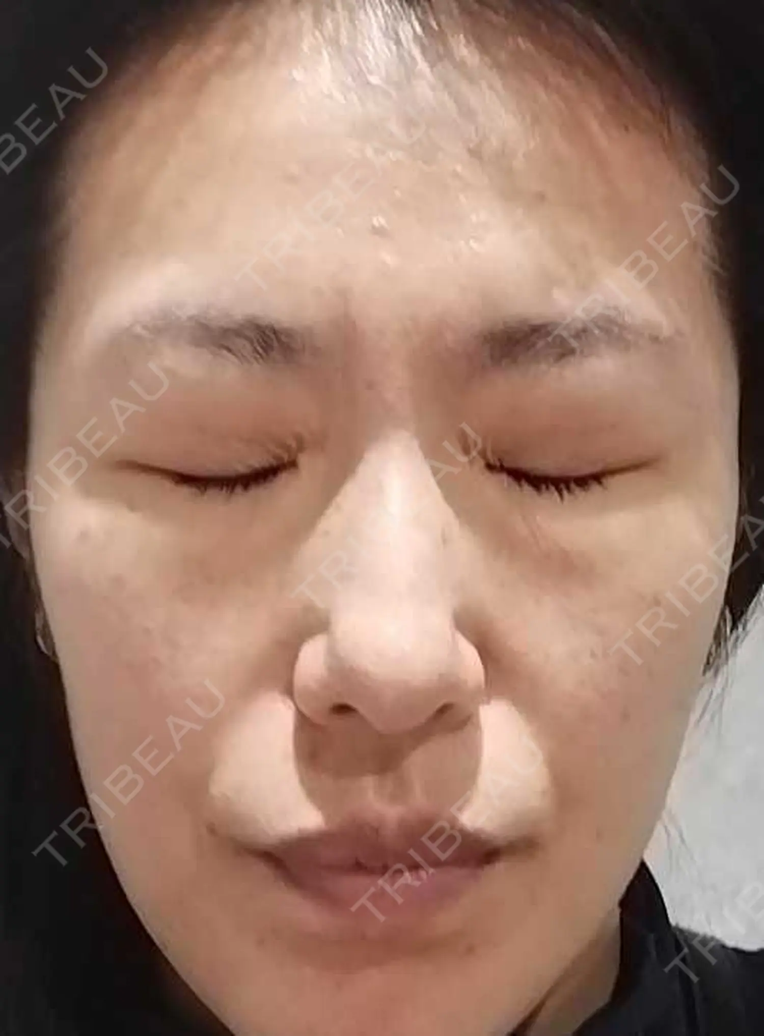 施術後の写真