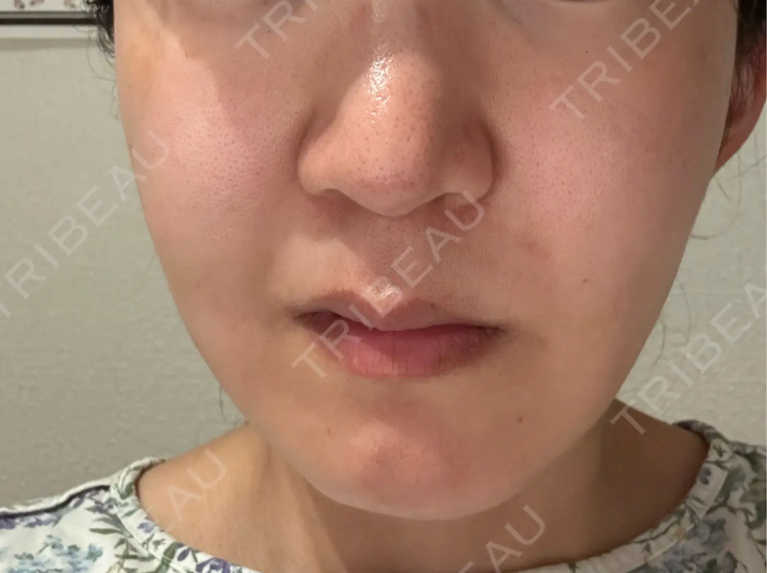 施術後の写真