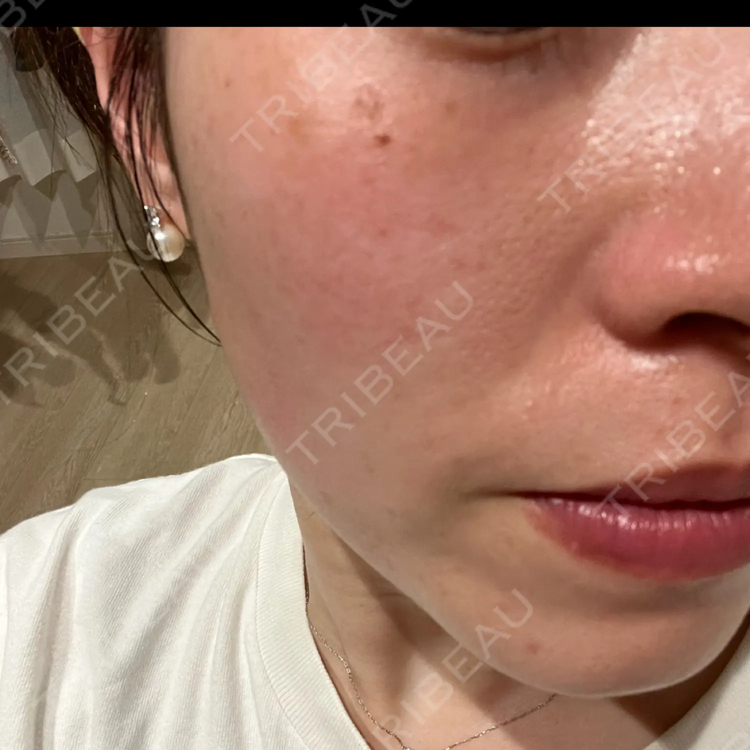 施術後の写真