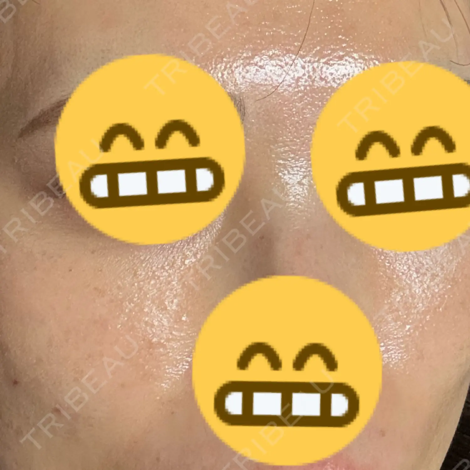 施術後の写真