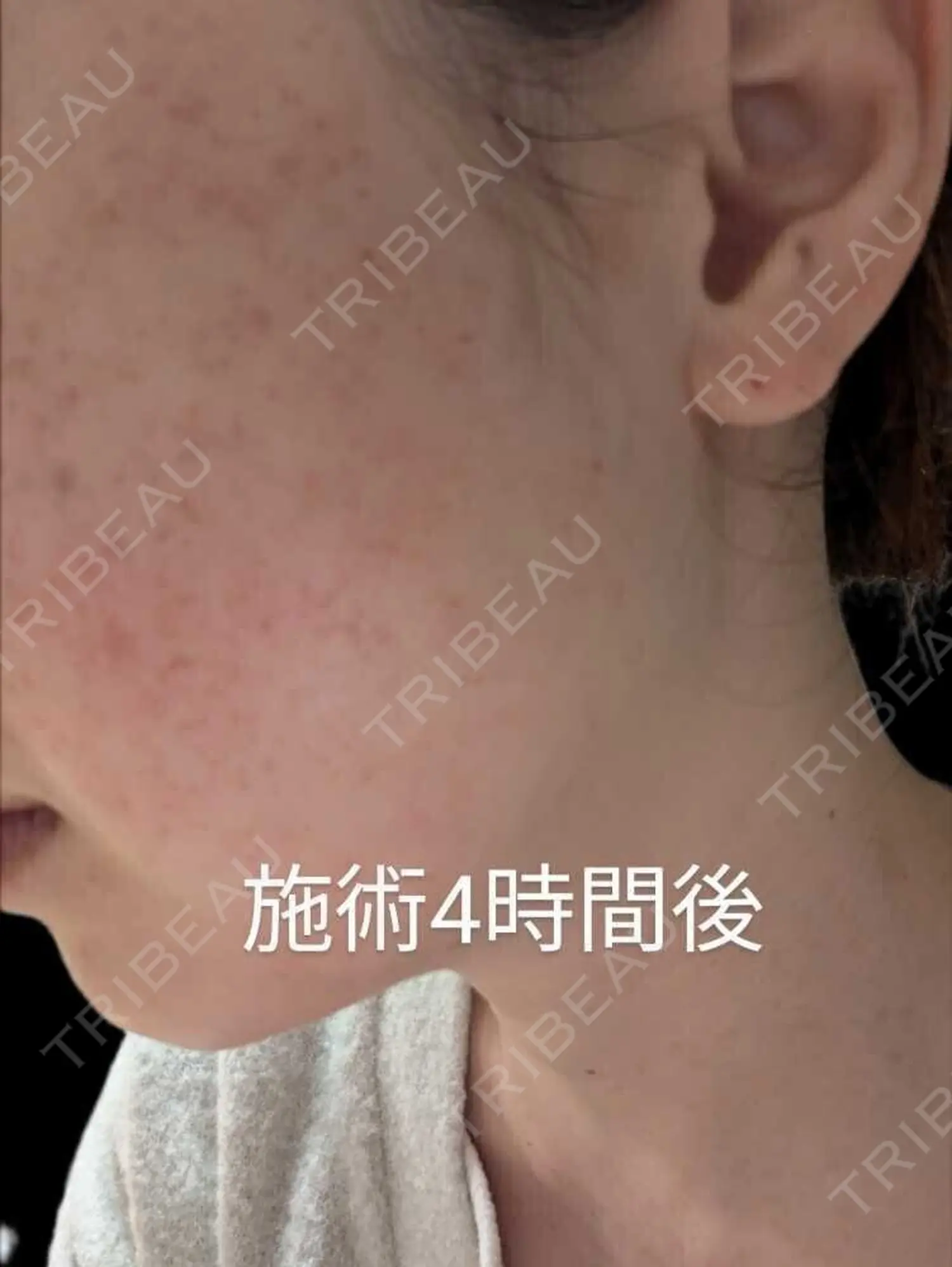 施術後の写真