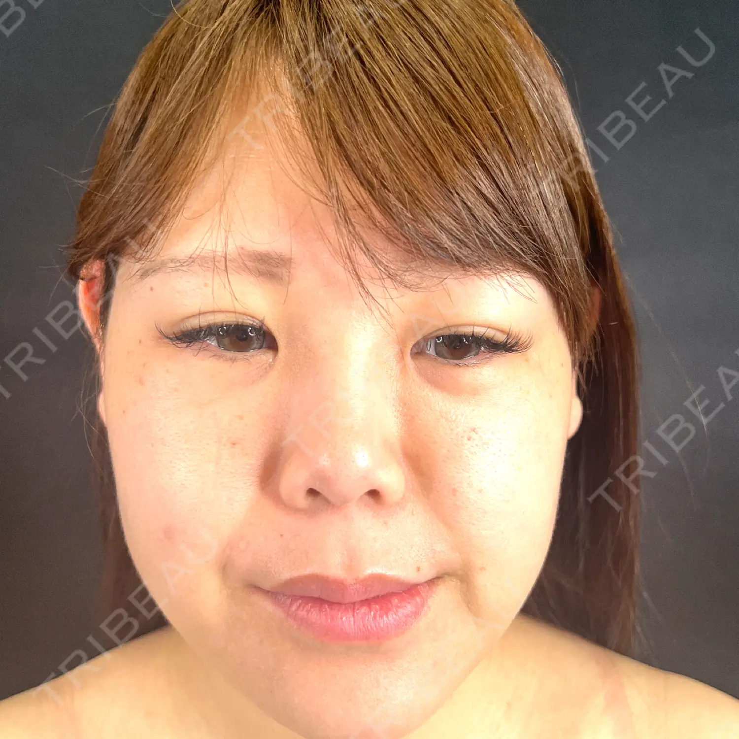 施術後の写真