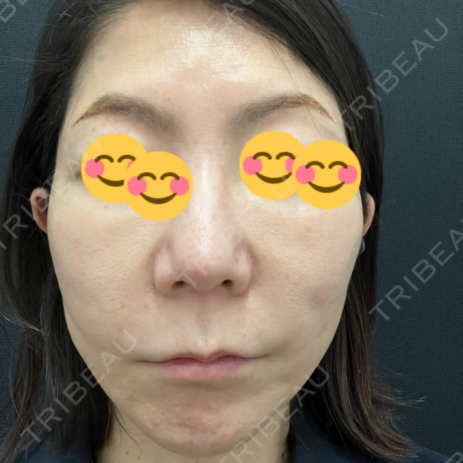 施術後の写真