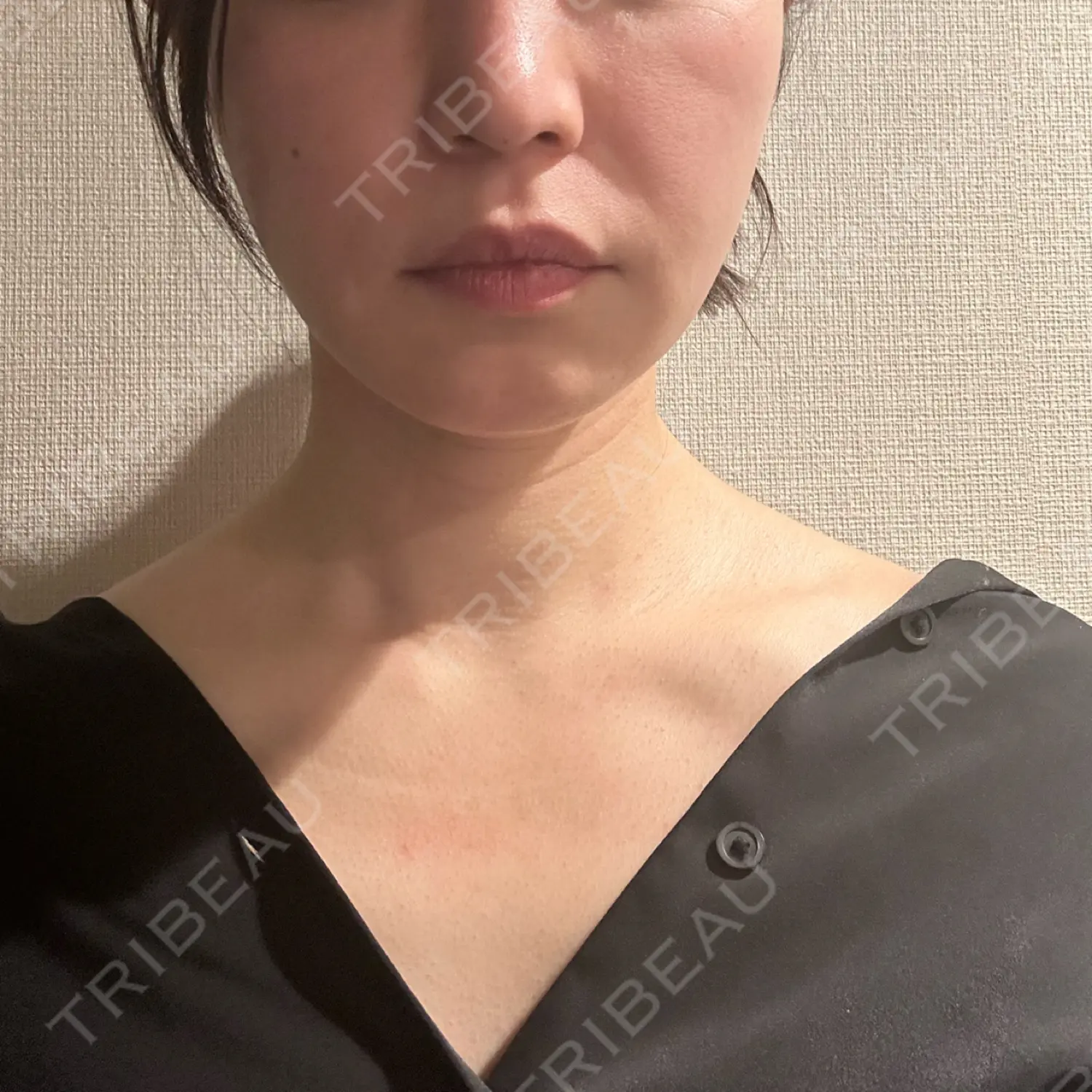 施術後の写真