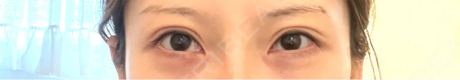 施術後の写真