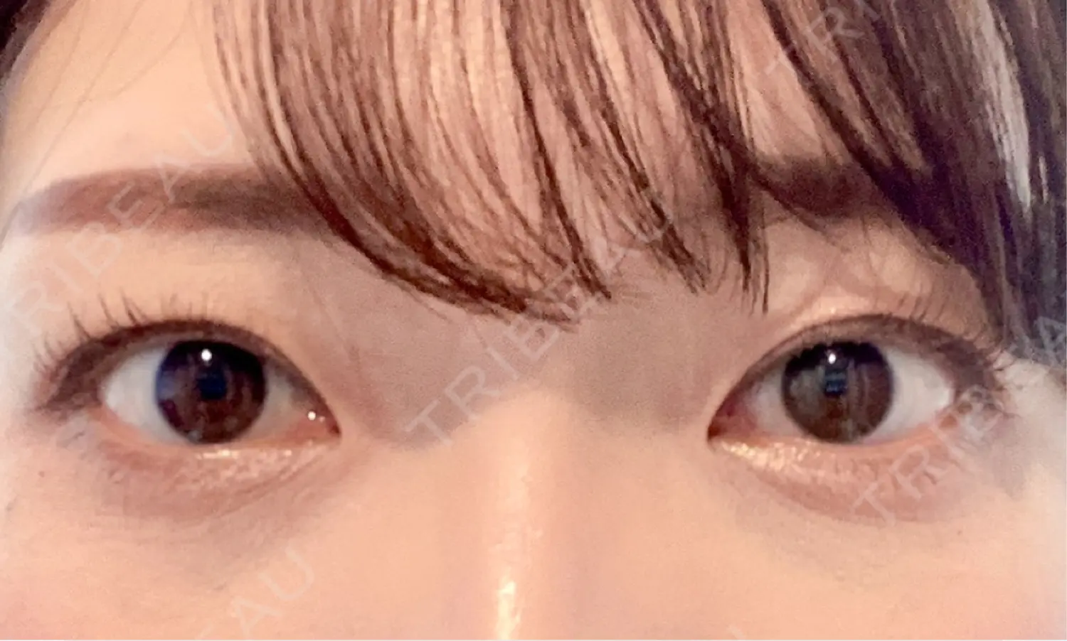 施術後の写真